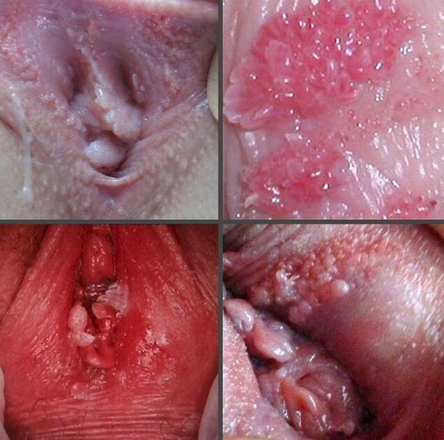 Close-up view of papillomas in the vagina