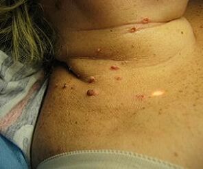 human papilloma virus in the neck