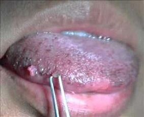 human papilloma virus in the tongue