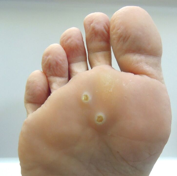 how to get rid of warts by walking