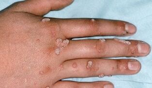 types of warts and their removal methods